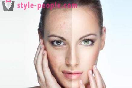 Azelainsyra peeling: recensioner kosmetologer, bilder före och efter