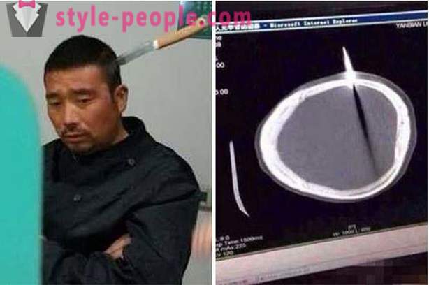 En kinesisk man med en kniv i huvudet gick han till läkaren