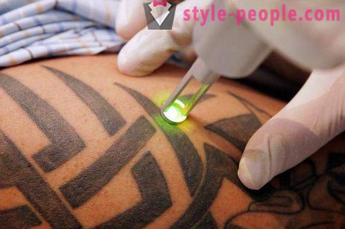Laser borttagning av tatueringar. granskat