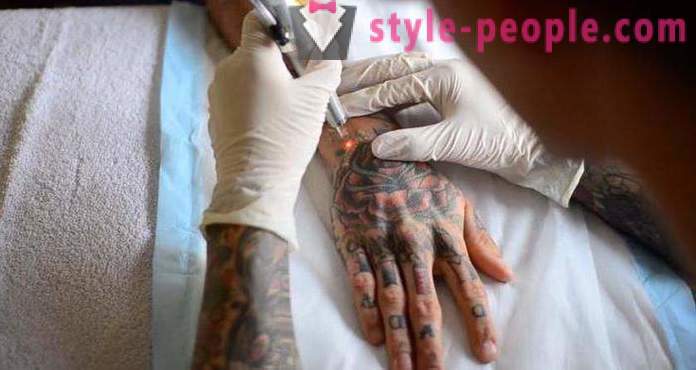 Laser borttagning av tatueringar. granskat