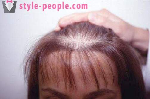 Darsonval hår. Ansökan darsonvalya för behandling och förebyggande av håravfall