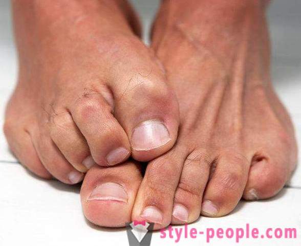 Torr hud på fötterna: Orsaker