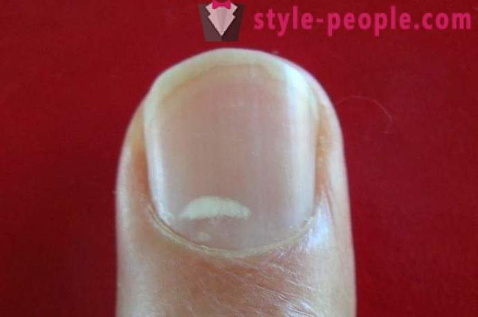 Vad gör vita fläckar på naglarna