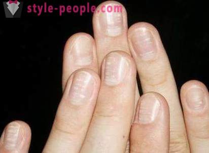 Vad gör vita fläckar på naglarna